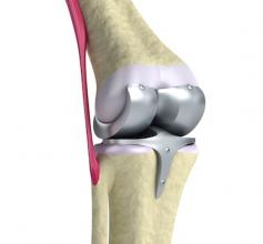 Artificial Joint